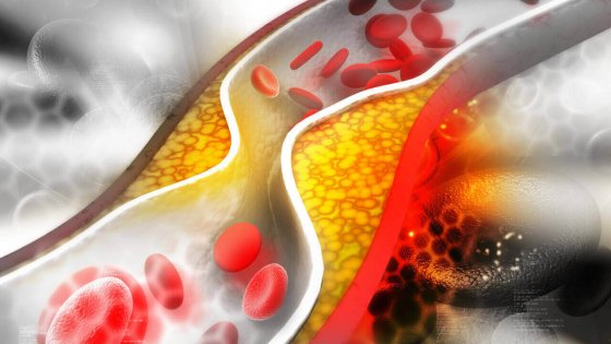 Xolesterin və ürək sağlamlığı