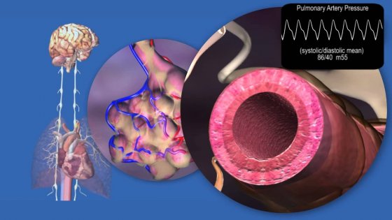 Pulmonar arteriya denervasiyası Pulmonar arteriya denervasiyası