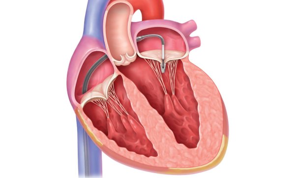Mitral və aortal stenoz