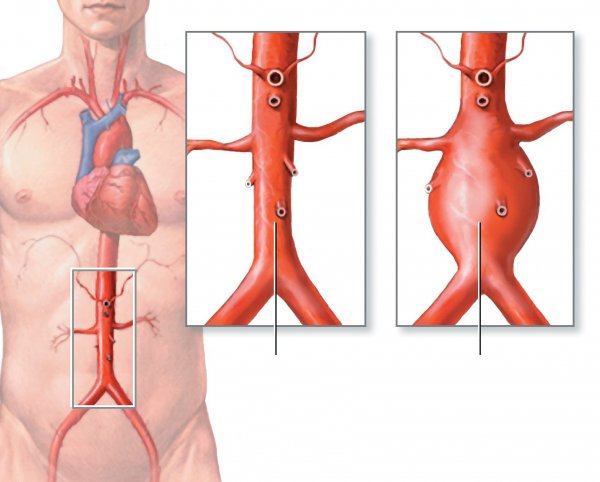 Aorta xəstəliklərində müdaxilələr Aorta xəstəliklərində müdaxilələr