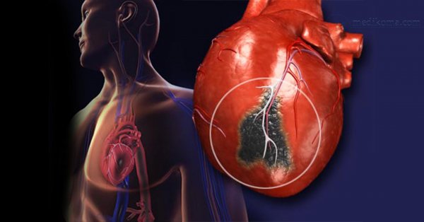 Bəzi xəstələr ağrı olmadanda infarkt keçirə bilər