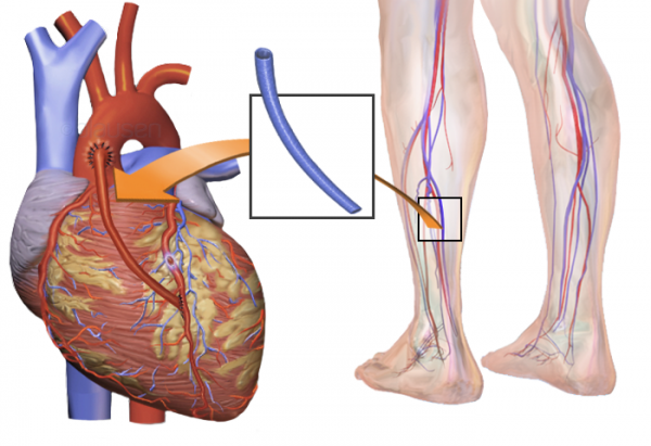 Hansı ürək əməliyyatı?, Stent yoxsa arterial koronar şuntlama?